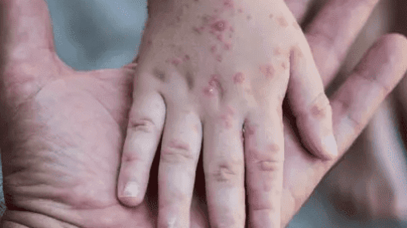 وزارة الصحة: فلسطين لم تسجل أي إصابة بجدري القرود