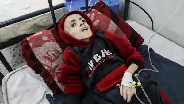 ارتفاع عدد ضحايا سوء التغذية في قطاع غزة إلى 18 شهيد