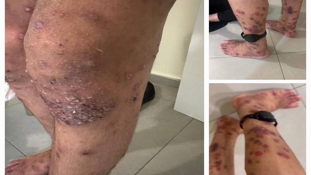 تحقيق لـ"هآرتس": ربع الأسرى أصيبوا بمرض الجرب مؤخرا