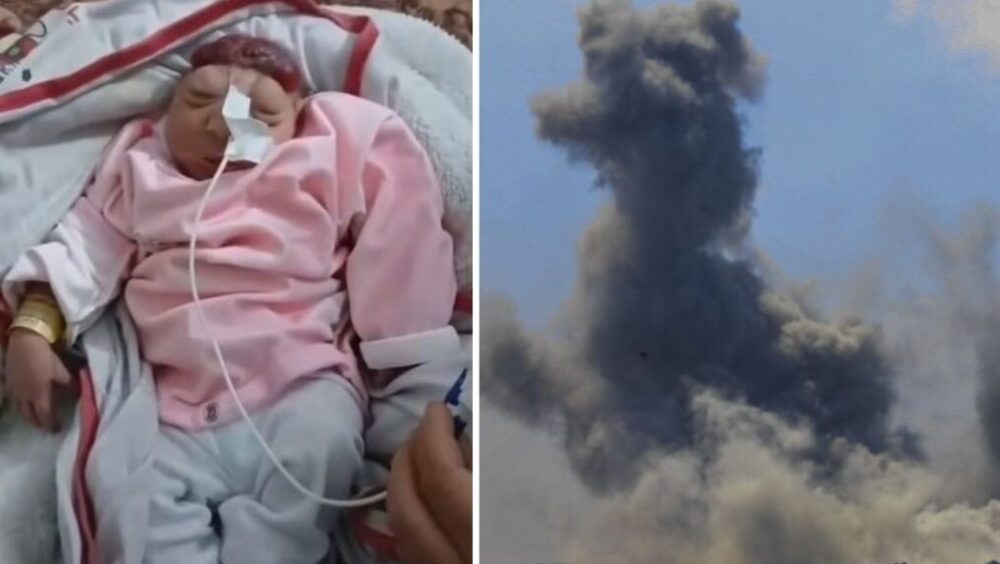 ولادة طفلة "بلا دماغ" مع تزايد ظاهرة "تشوه الأجنة" في قطاع غزة