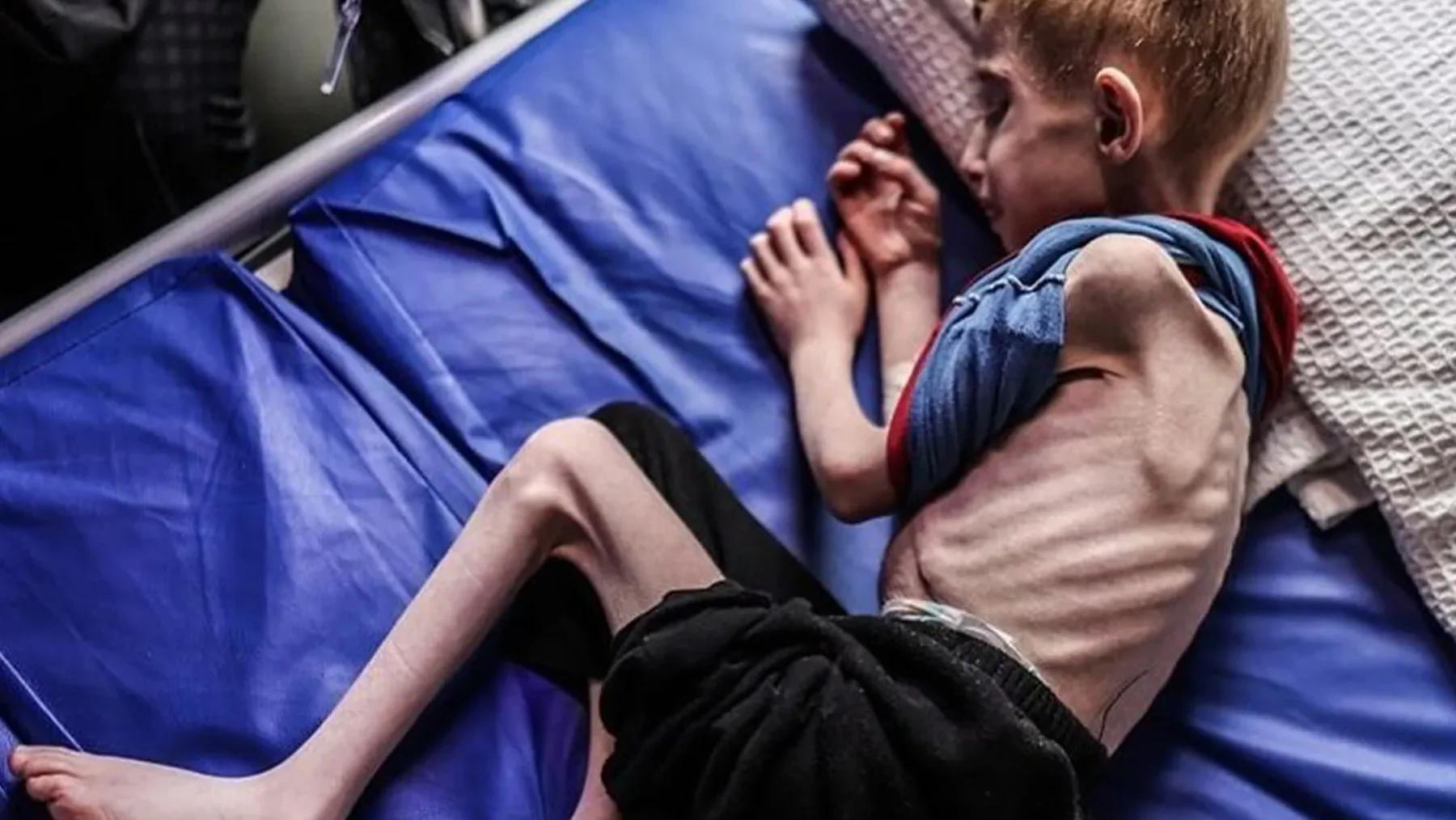 "الأونروا": أكثر من 2700 طفل في غزة أصيبوا بسوء تغذية حاد