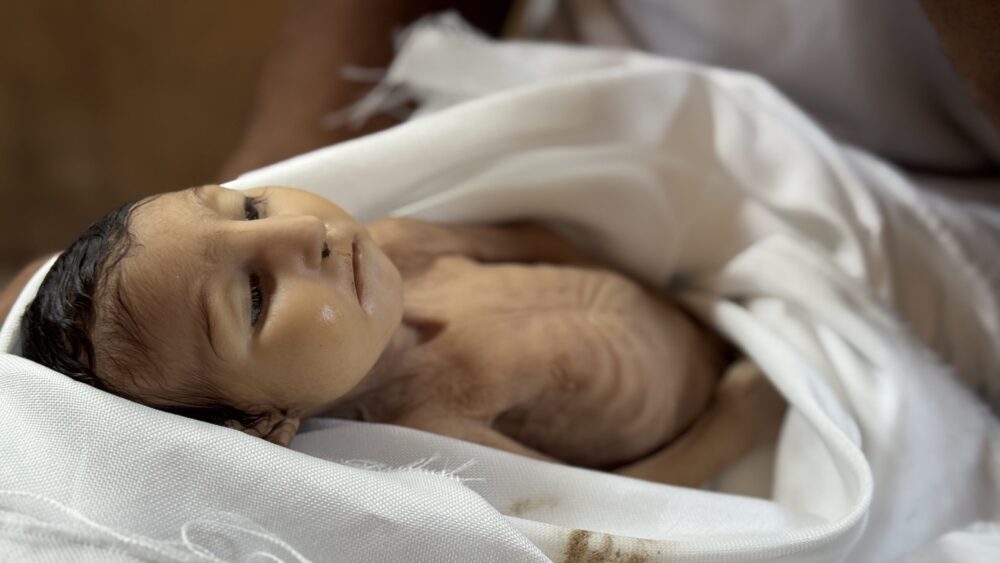 استشهاد رضيعة جراء سوء التغذية في خانيونس