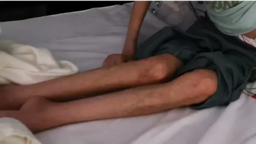 ما هي متلازمة "غيلان باريه" ولماذا تنذر بكارثة جديدة في قطاع غزة؟