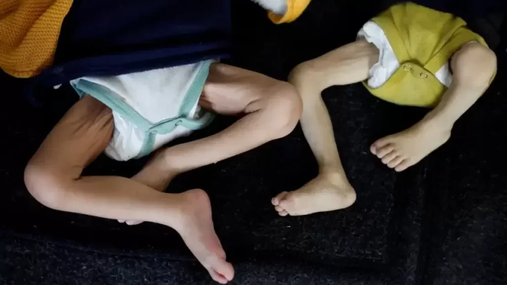 التجويع يفتك بالفلسطينيين في غزة.. ارتفاع شهداء سوء التغذية إلى 235