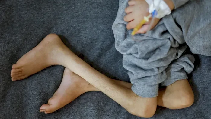 6 وفيات من بينها طفلان نتيجة المجاعة وسوء التغذية خلال الـ24 ساعة الماضية