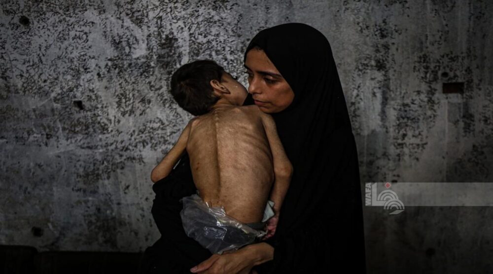 5 وفيات من بينهم 3 أطفال نتيجة المجاعة وسوء التغذية خلال الـ24 ساعة الماضية