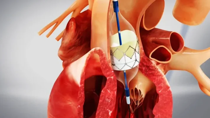 النوبات القلبية قد يكون سببها عدوى بكتيرية في الشرايينالنوبات القلبية قد يكون سببها عدوى بكتيرية في الشرايين