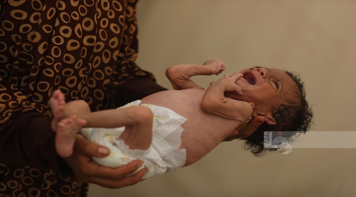 6 وفيات نتيجة التجويع في غزة خلال الساعات الـ24 الماضية