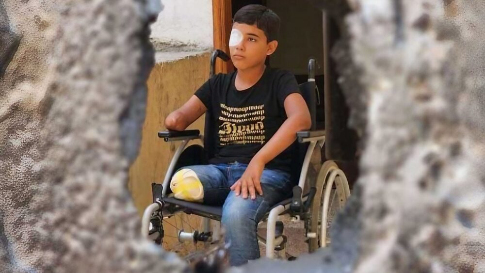 الصحة العالمية: أكثر من 15 ألف شخص بترت أطرافهم جراء حرب غزة