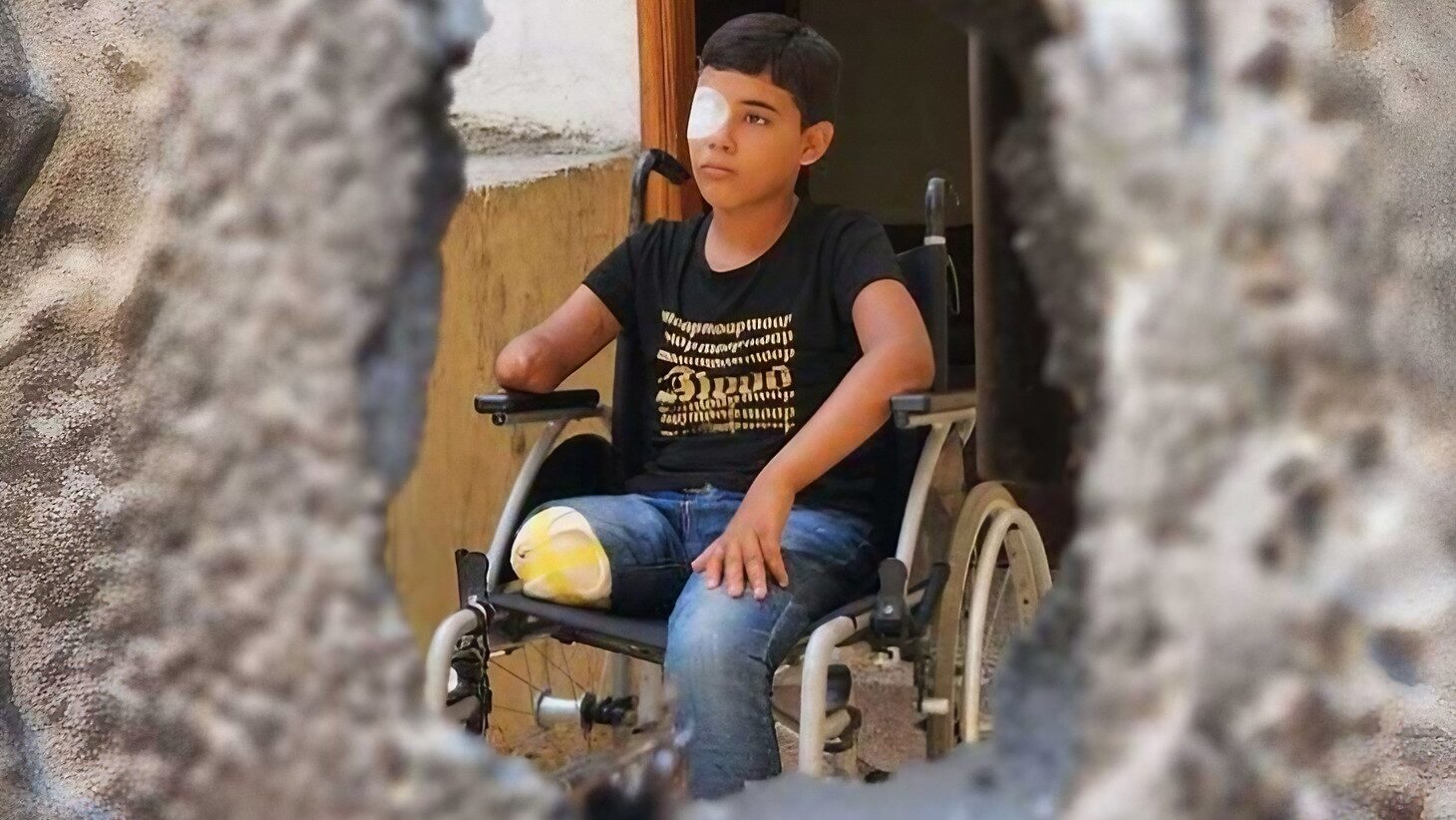 الصحة العالمية: أكثر من 15 ألف شخص بترت أطرافهم جراء حرب غزة