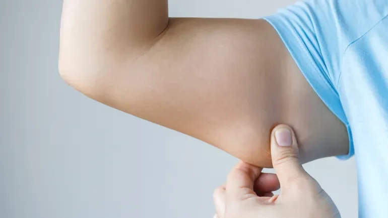 أفضل علاجات ترهل الجلد بعد فقدان الوزن