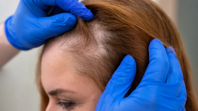 تساقط الشعر عند النساء.. الأسباب والعلاج وأبرز العلامات