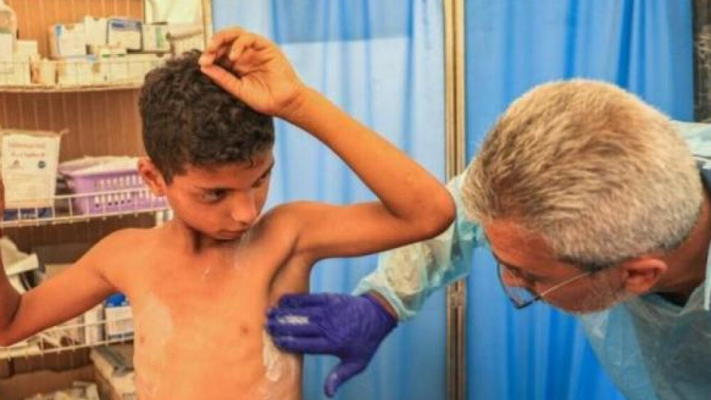 الأمم المتحدة تُحذر من تفشٍ واسع لـ "جدري الماء" يُهدد النازحين في قطاع غزة