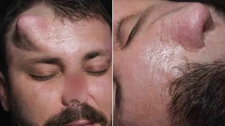 جرّاح عراقي يعيد بناء أنف في جبين مريض